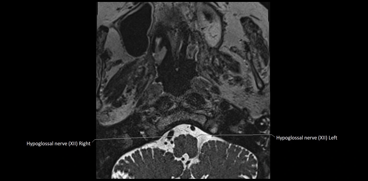 Cranial nerve anatomy axial MRI 3T image 78.webp